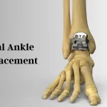 Total Ankle Replacement