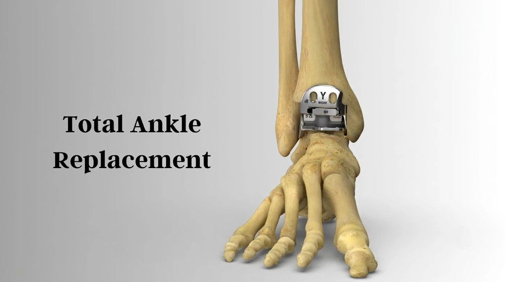 Total Ankle Replacement