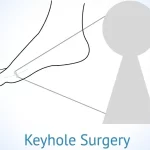 Minimally Invasive Surgery of the Foot & Ankle