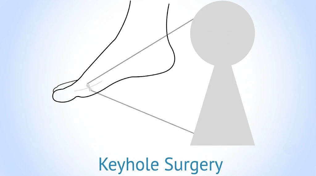 Minimally Invasive Surgery of the Foot & Ankle