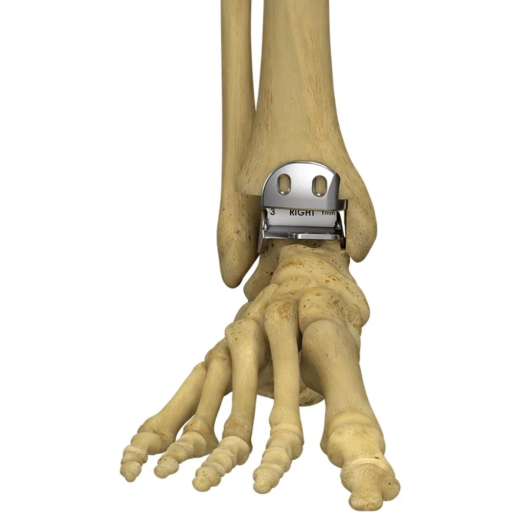 Ankle Replacement