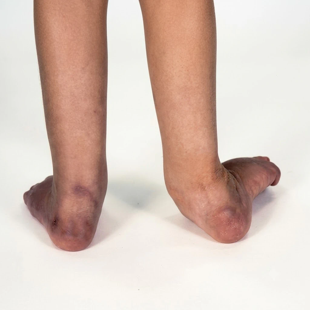 Foot & Ankle Deformity Correction