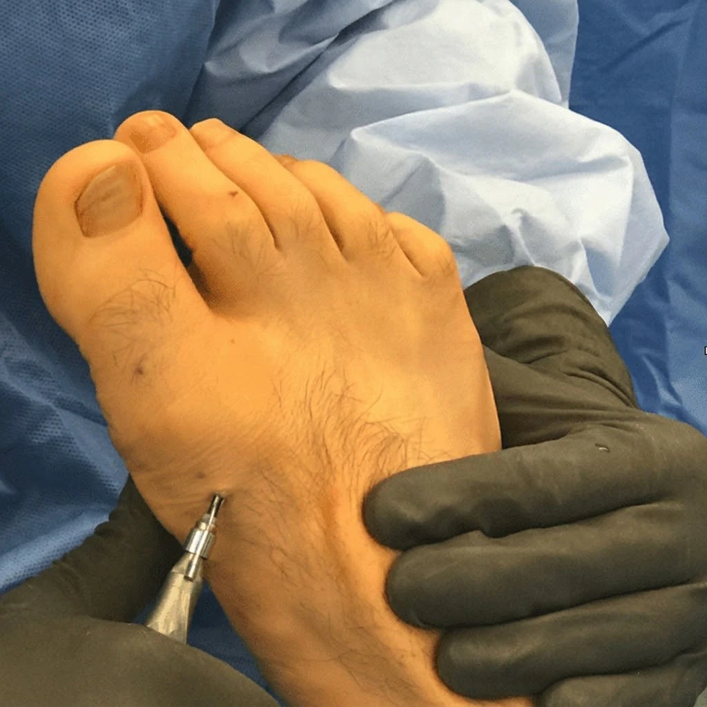 Minimally Invasive Surgery Foot & Ankle